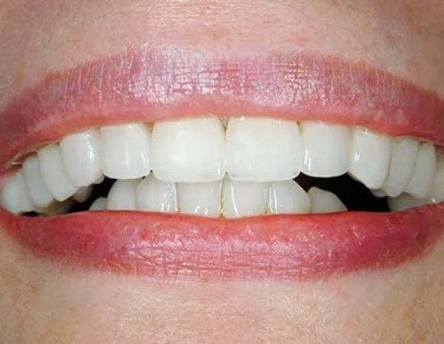 Case 1 after