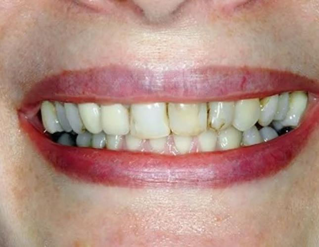 Case 1 before
